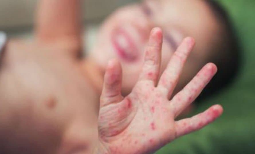 अमेरिकामा दादुराको प्रकोप तीव्र, सङ्क्रमितको सङ्ख्या ३ हजार पार
