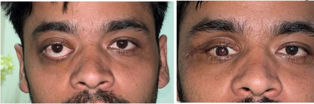 आँखा पछाडिको जटिल ट्युमर: जापानका चिकित्सकबाट निराश बनेका सुजनको जब डा. रोहित सैंजुसहितको टोलीले बचायो दृष्टि